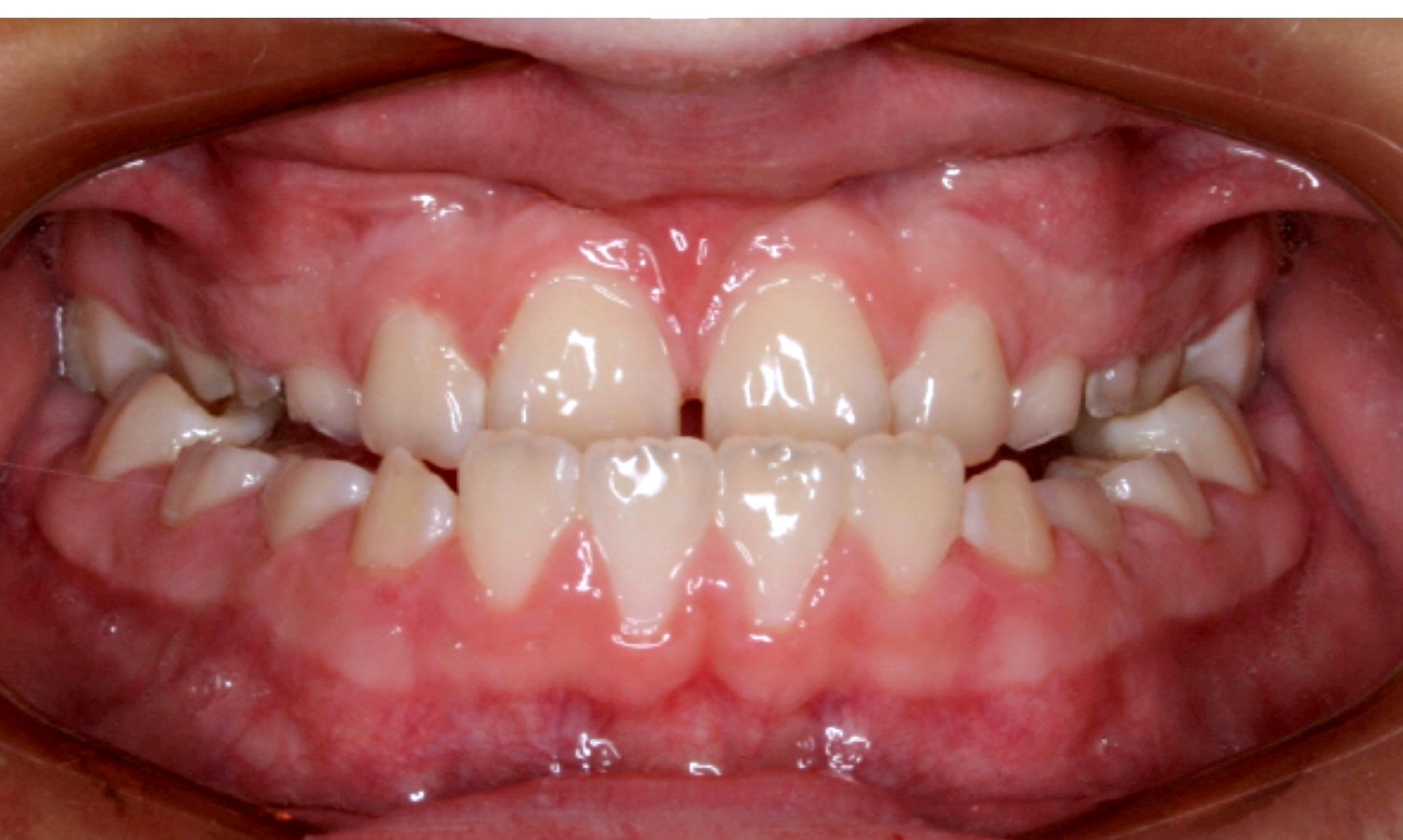 underbite-rix-orthodontics-calgary-ab